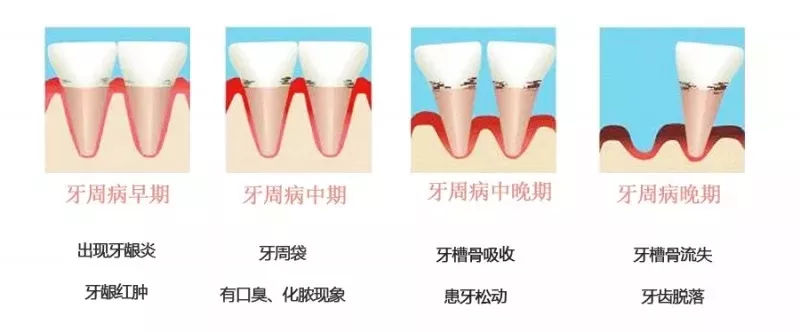 牙周炎的自我检查