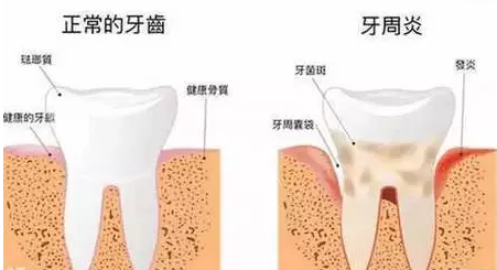   牙周炎是比较常见的一种牙齿疾病,一般比较常见于